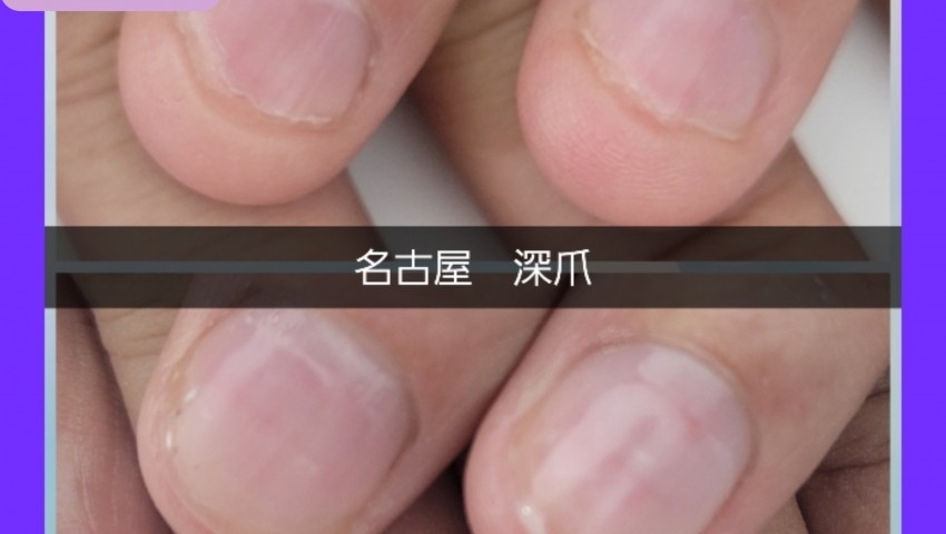 深爪2ヶ月経過のお客様　卒業