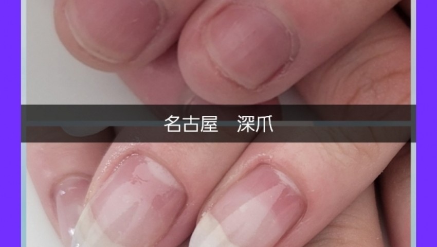 深爪　１ヶ月経過のお客様