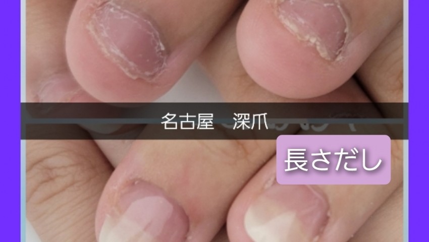 深爪　長さだし自然な仕上がり