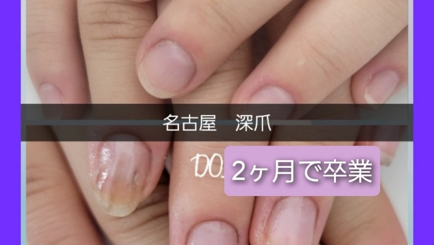 深爪　2ヶ月で卒業のお客様