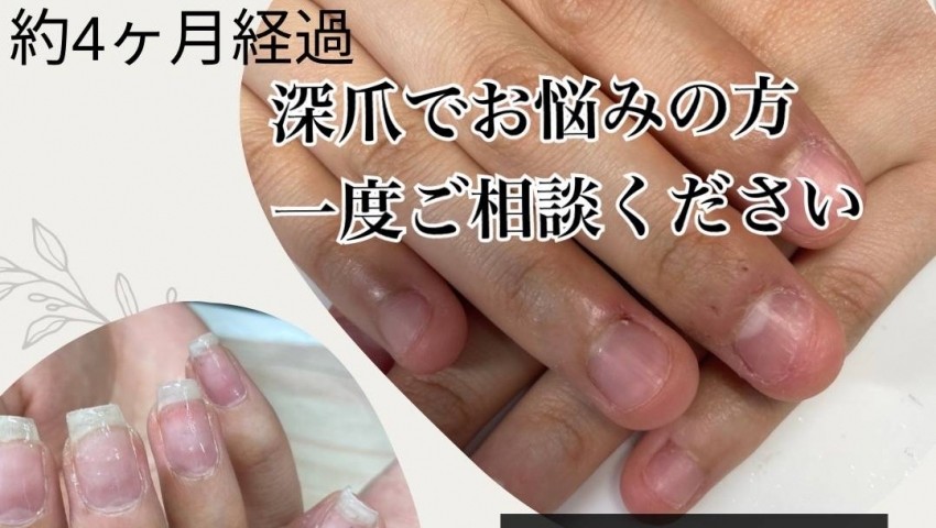 深爪４ヶ月経過のお客様