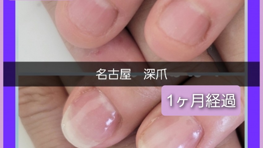 深爪1ヶ月経過のお客様
