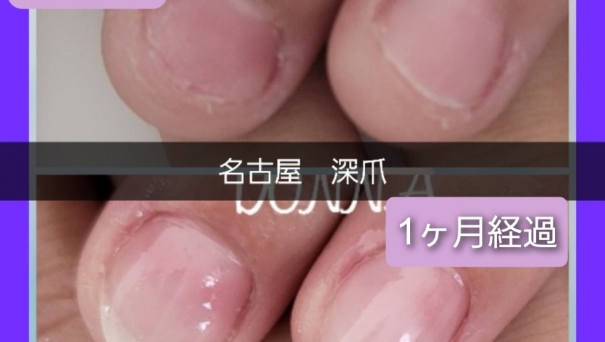 深爪1ヶ月経過のお客様
