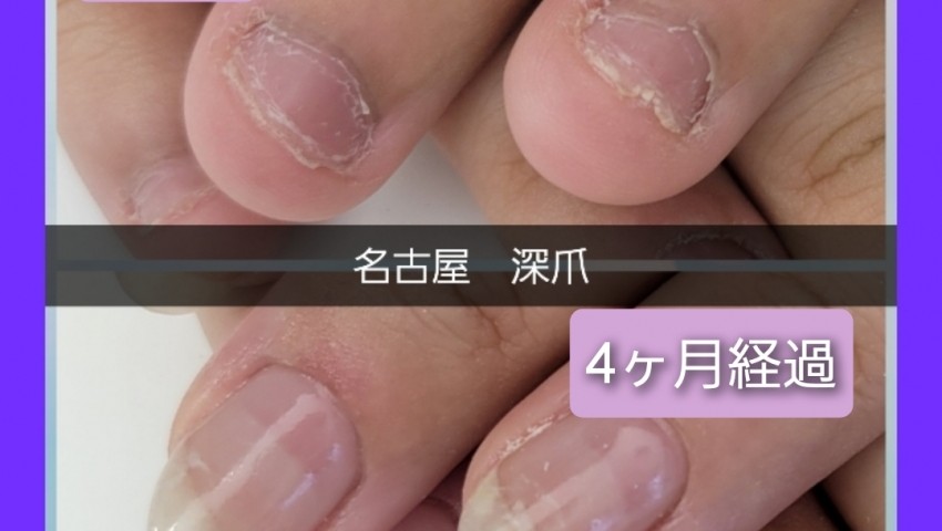 深爪4ヶ月経過のお客様