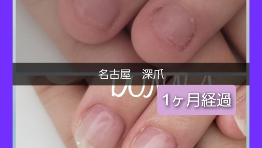 深爪　1ヶ月半経過のお客様