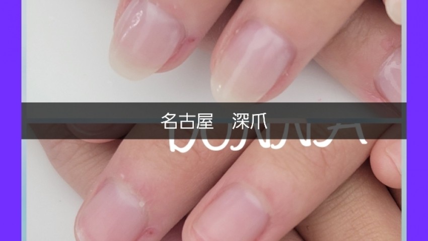 深爪　長さだし