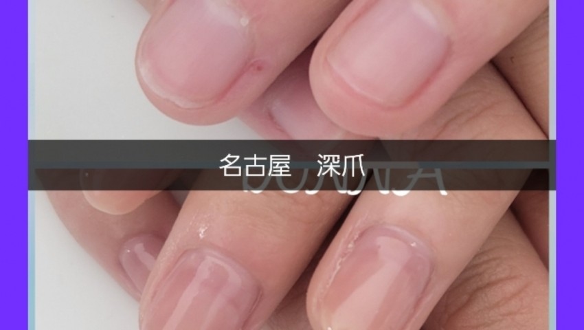 深爪　1ヶ月経過のお客様