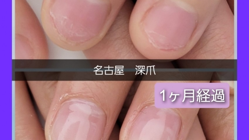 深爪1ヶ月経過のお客様