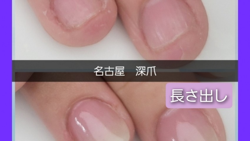 深爪　保育士さんの長さだし　
