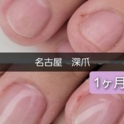 深爪1ヶ月経過のお客様