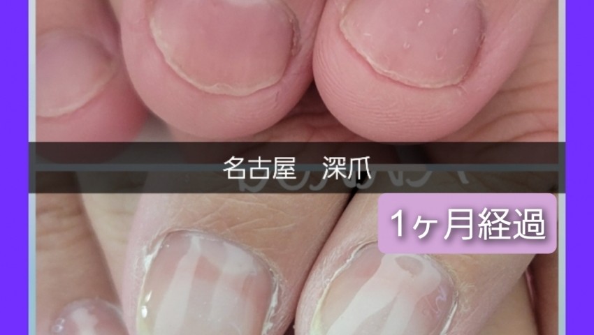 深爪1ヶ月経過のお客様