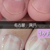 深爪1ヶ月経過のお客様