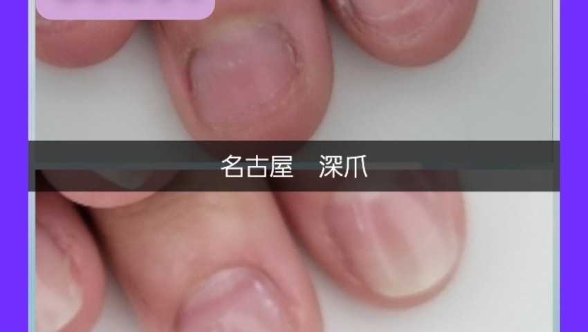 深爪　長さだし