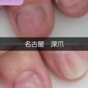 深爪　長さだし