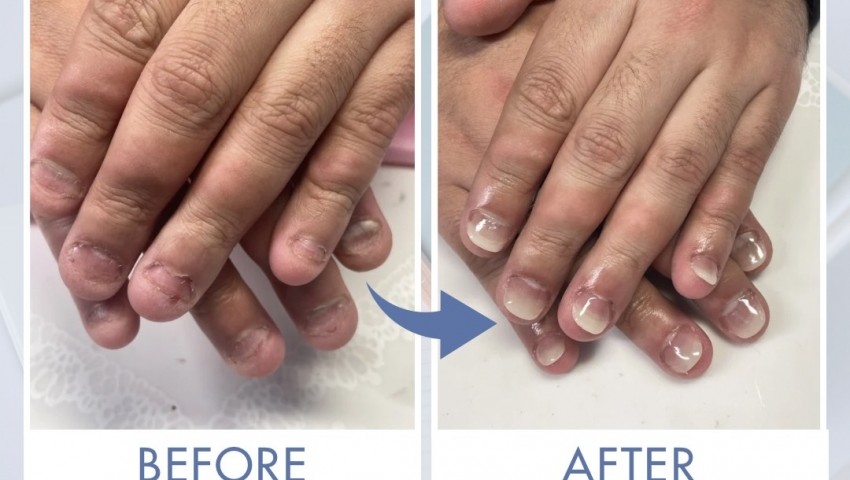 深爪に戻っても大丈夫！