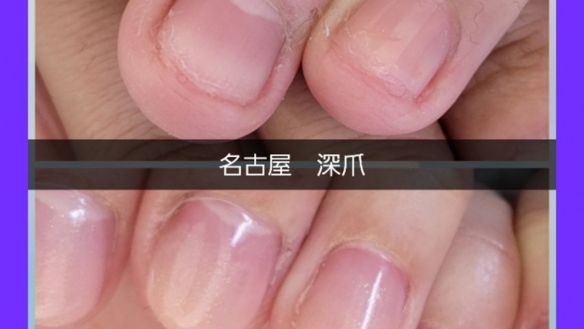 深爪長さだし+カラー