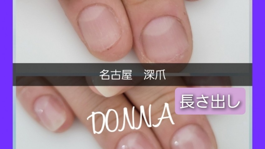 深爪　長さ出しのお客様