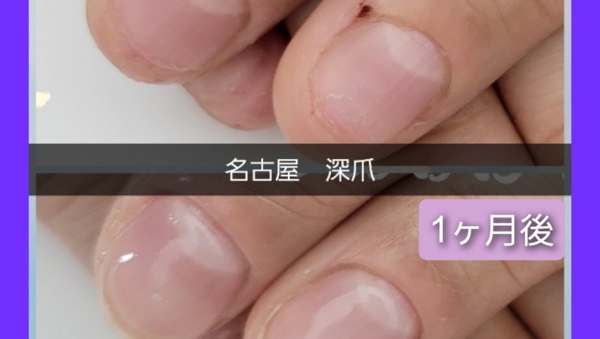深爪1ヶ月経過のお客様