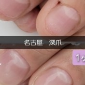 深爪1ヶ月経過のお客様