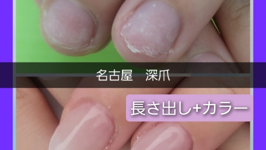深爪長さ出し+カラー
