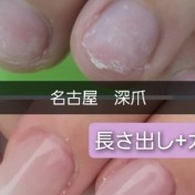 深爪長さ出し+カラー